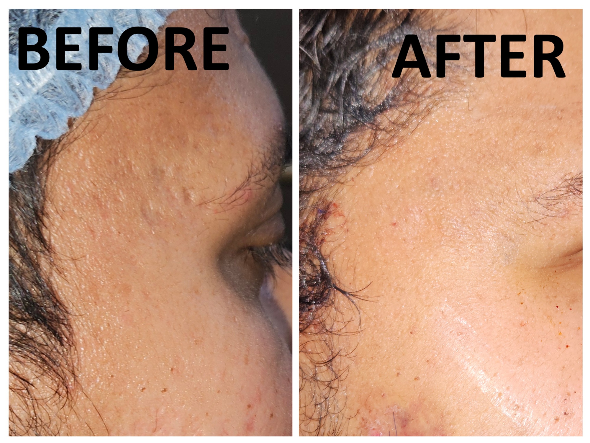 Lipoma
